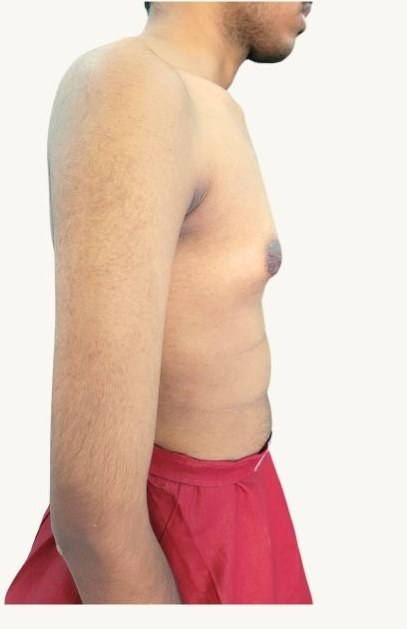 Before gynecomastia surgery — Grade I gynecomastia