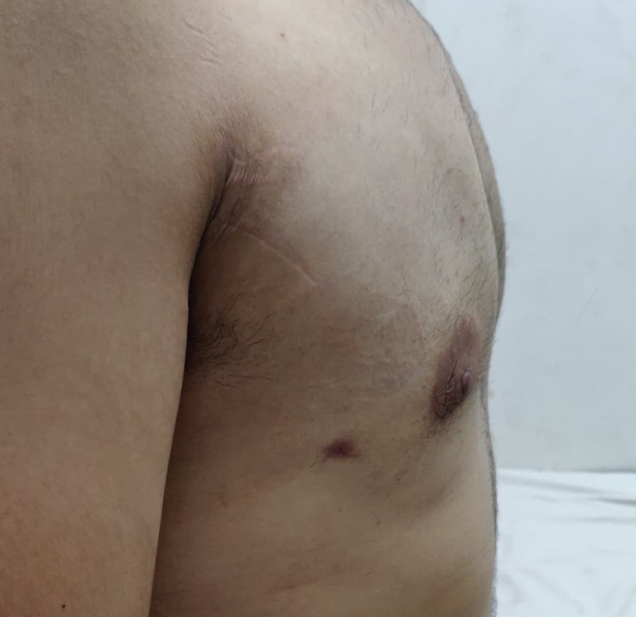Close-up of a healed gynecomastia surgery scar on the side of the chest near the armpit