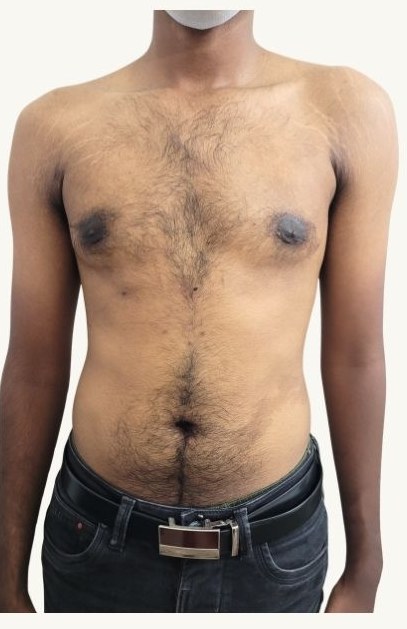 Gynecomastia surgery in Chennai — Puffy nipple gynecomastia, Liposuction + gland excision, Dr. Charan J.C. VSculpt — after surgery