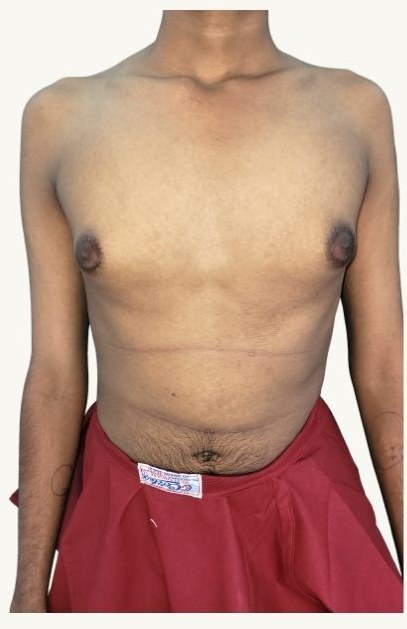 Gynecomastia surgery in Chennai — Puffy nipple gynecomastia, Liposuction + gland excision, Dr. Charan J.C. VSculpt — before surgery