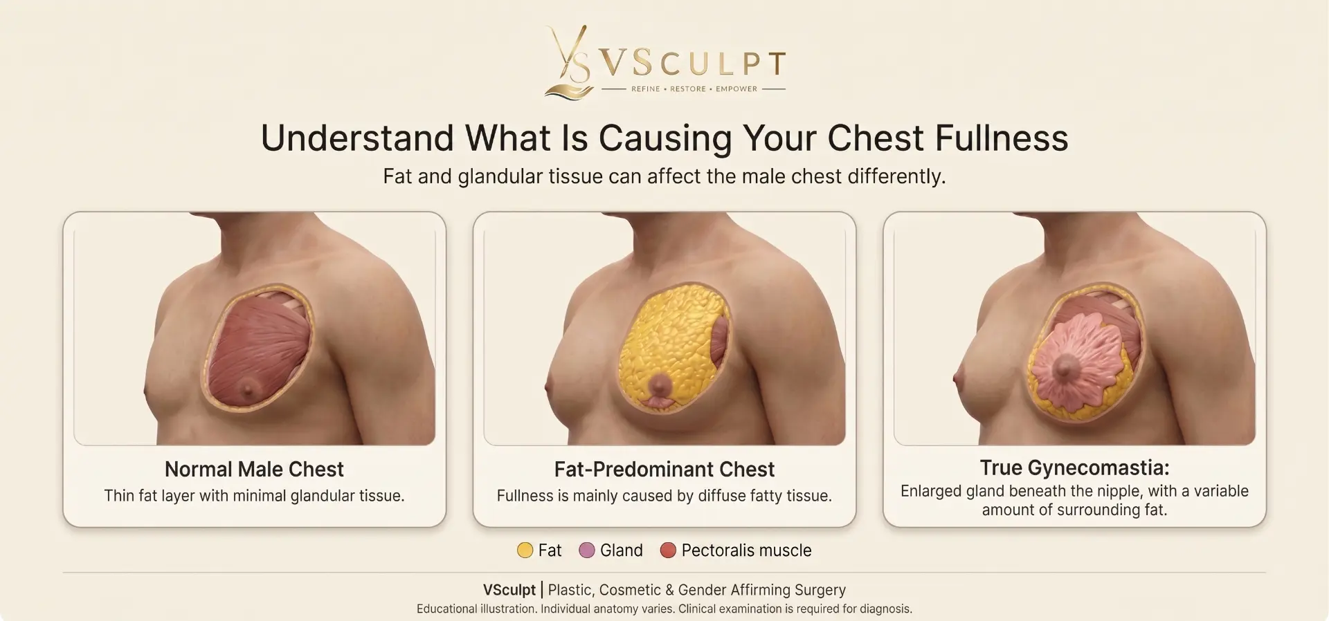 Comparison of a normal male chest, a fat-predominant chest and true gynecomastia with gland and fat