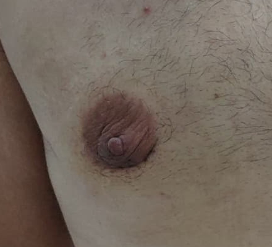 Close-up of a healed gynecomastia surgery scar along the lower border of the areola