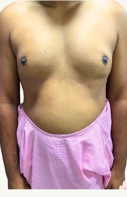 Before gynecomastia surgery — Grade IIA gynecomastia